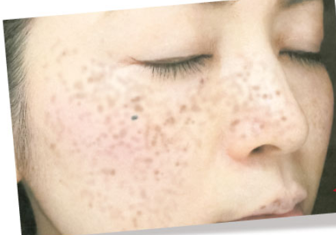 実録 私とシミの10日間