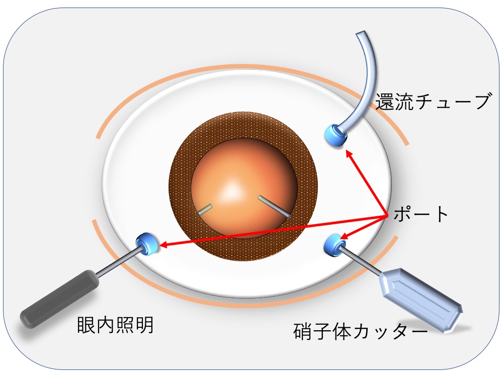 硝子体手術｜松山市駅近くの眼科あおば眼科クリニック
