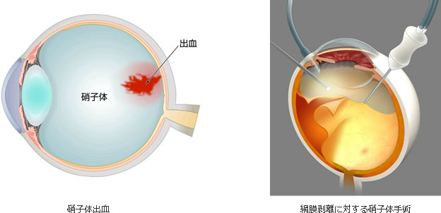 網膜硝子体手術 | ハイマート眼科