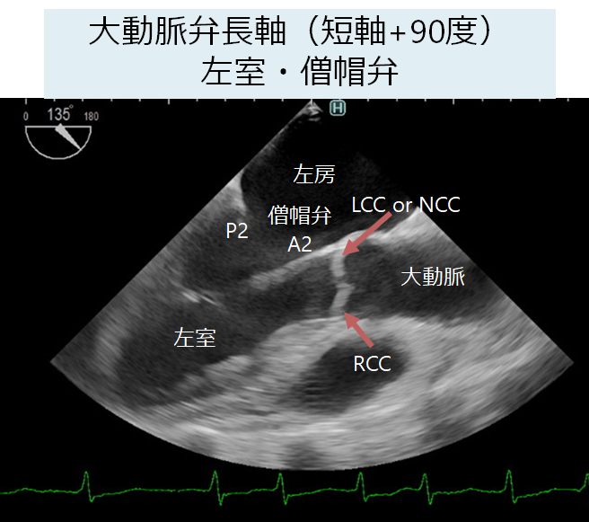 経食道心エコー検査 TEE: transesophageal echo│医學事始 いがくこと