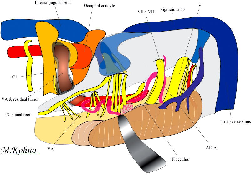 頭蓋底髄膜腫の手術