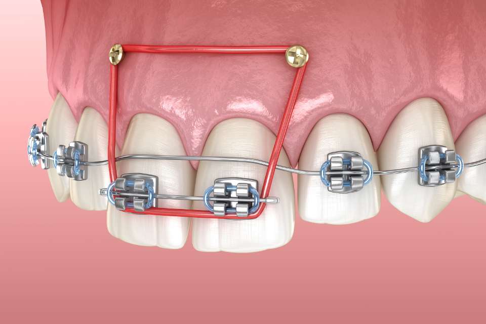 矯正歯科｜大田区千鳥の歯医者・インプラント わかば歯科クリニック