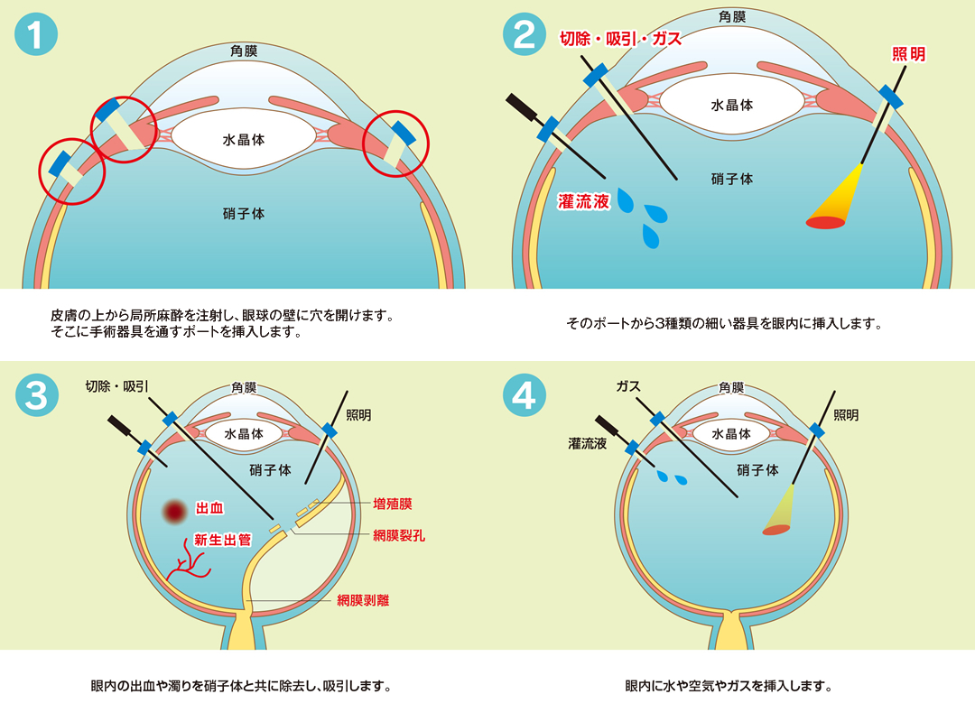 網膜硝子体手術 | 大阪府西成区岸里・天下茶屋の眼科は松本眼科へ