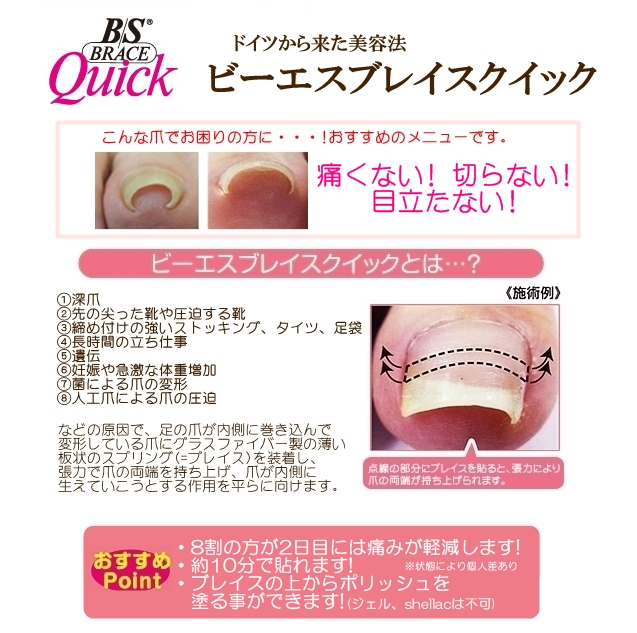 ドイツ式 巻爪矯正 B/Sブレイスクイック NEWS 新宿、中落合(落合南長崎