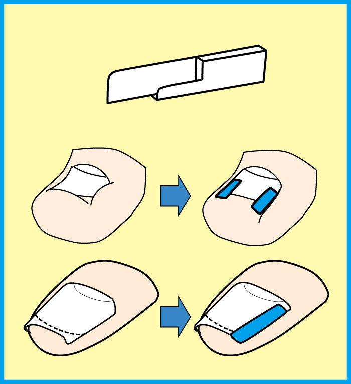 STD使用方法/巻き爪補正（ペディグラス）