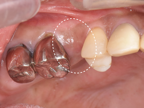 インプラント | ブルーラジカル歯周病治療 大阪 奈良 | Newスタイル