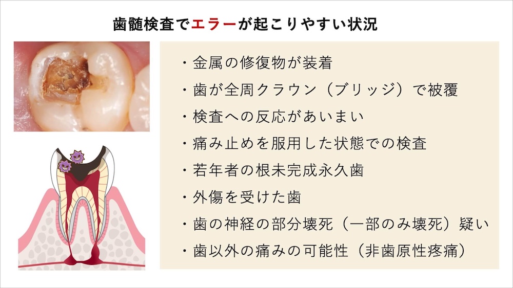 歯の神経が死んでいる」と言われた方へ｜神経の確認方法とセカンド