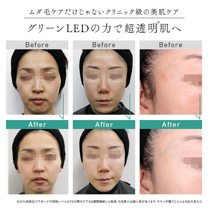 正規販売店］光美容器 脱毛器 ステラ ボーテ