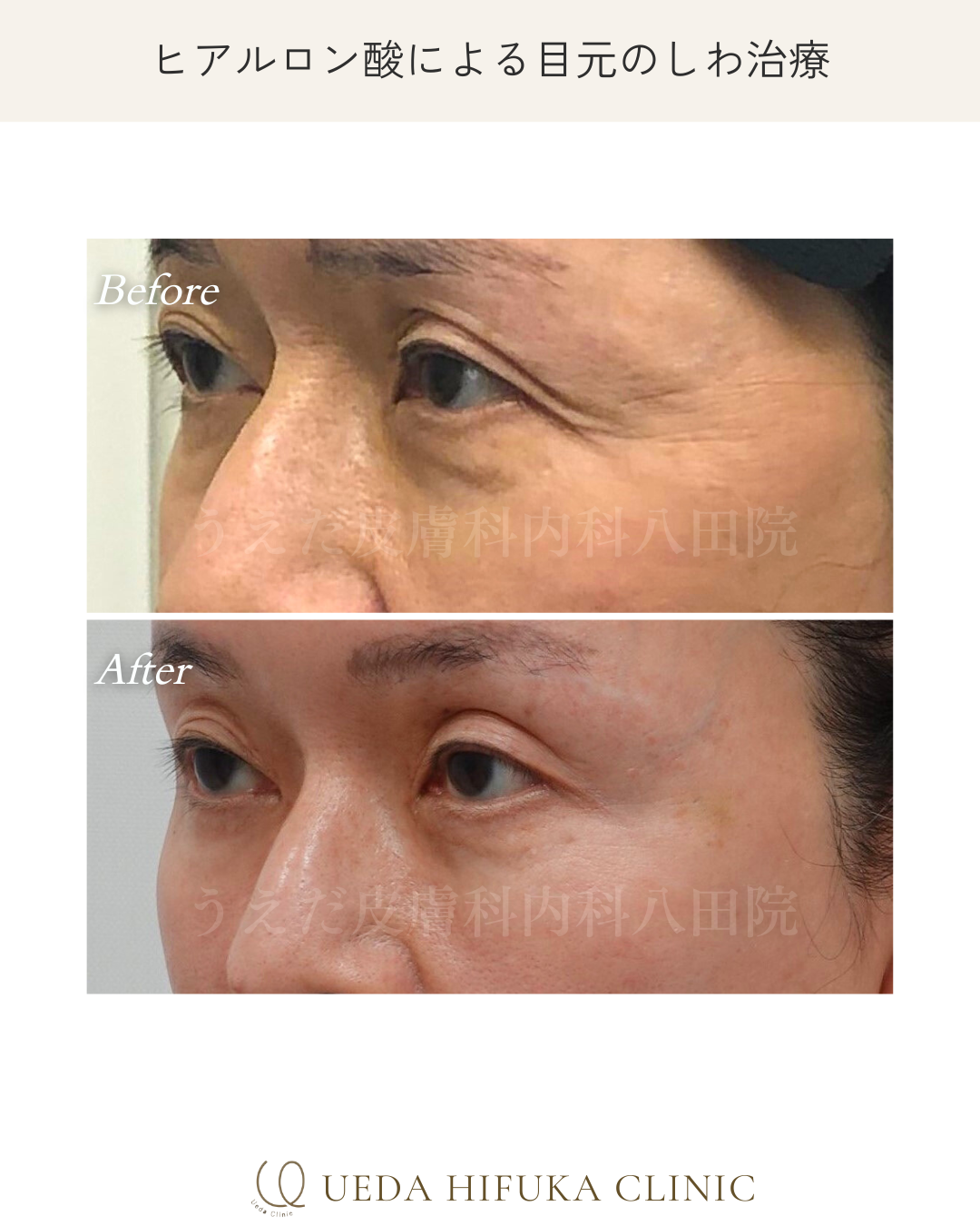 ヒアルロン酸注射 | うえだ皮膚科内科 八田院 | 名古屋市中川区