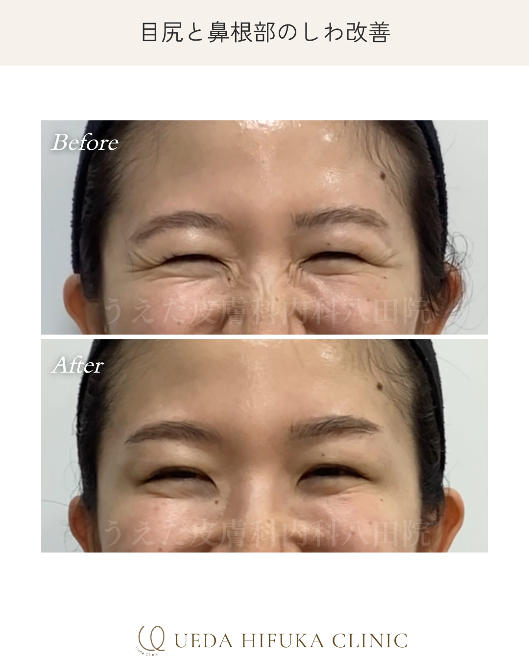 ボトックス注射 | うえだ皮膚科内科 八田院 | 名古屋市中川区