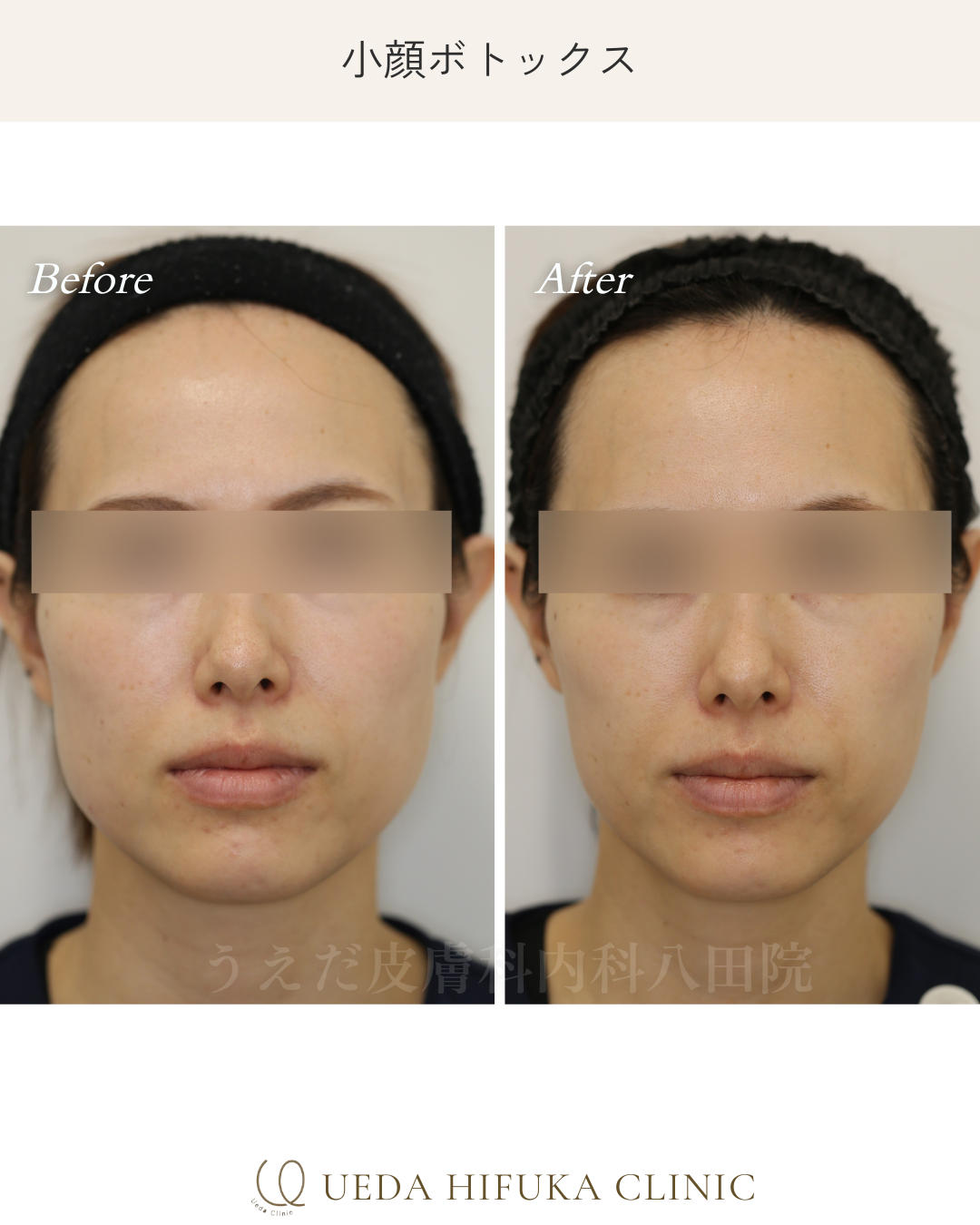 ボトックス注射 | うえだ皮膚科内科 八田院 | 名古屋市中川区