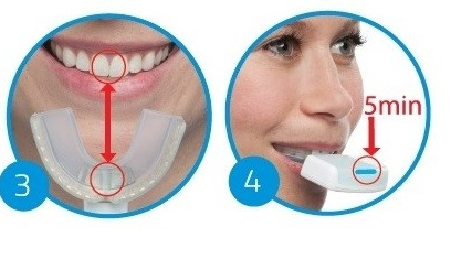 矯正期間の短縮につながる？オルソパルスとPBMヒーリング | 大阪市北区