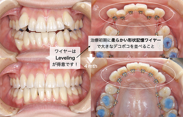 ハイブリッドでの治療 | 横浜の矯正歯科はSYNC横浜元町矯正歯科