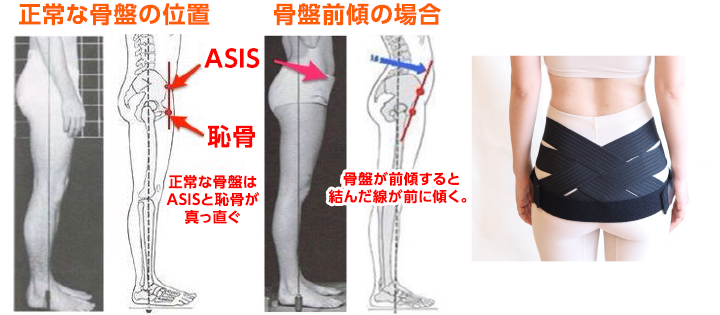反り腰を矯正できる唯一の骨盤ベルト 【ペルビス】 | 三徳接骨院三徳接骨院