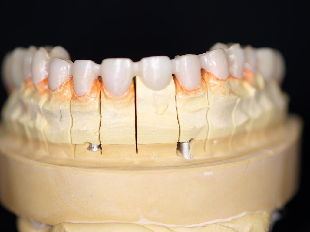ジルコニアクラウンフルマウスの作成 ｜広島市安佐南区の歯科医院