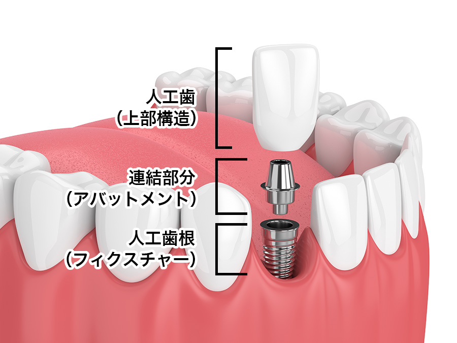 インプラントとセラミックの違い | 赤坂の美容歯科・審美歯科・歯医者