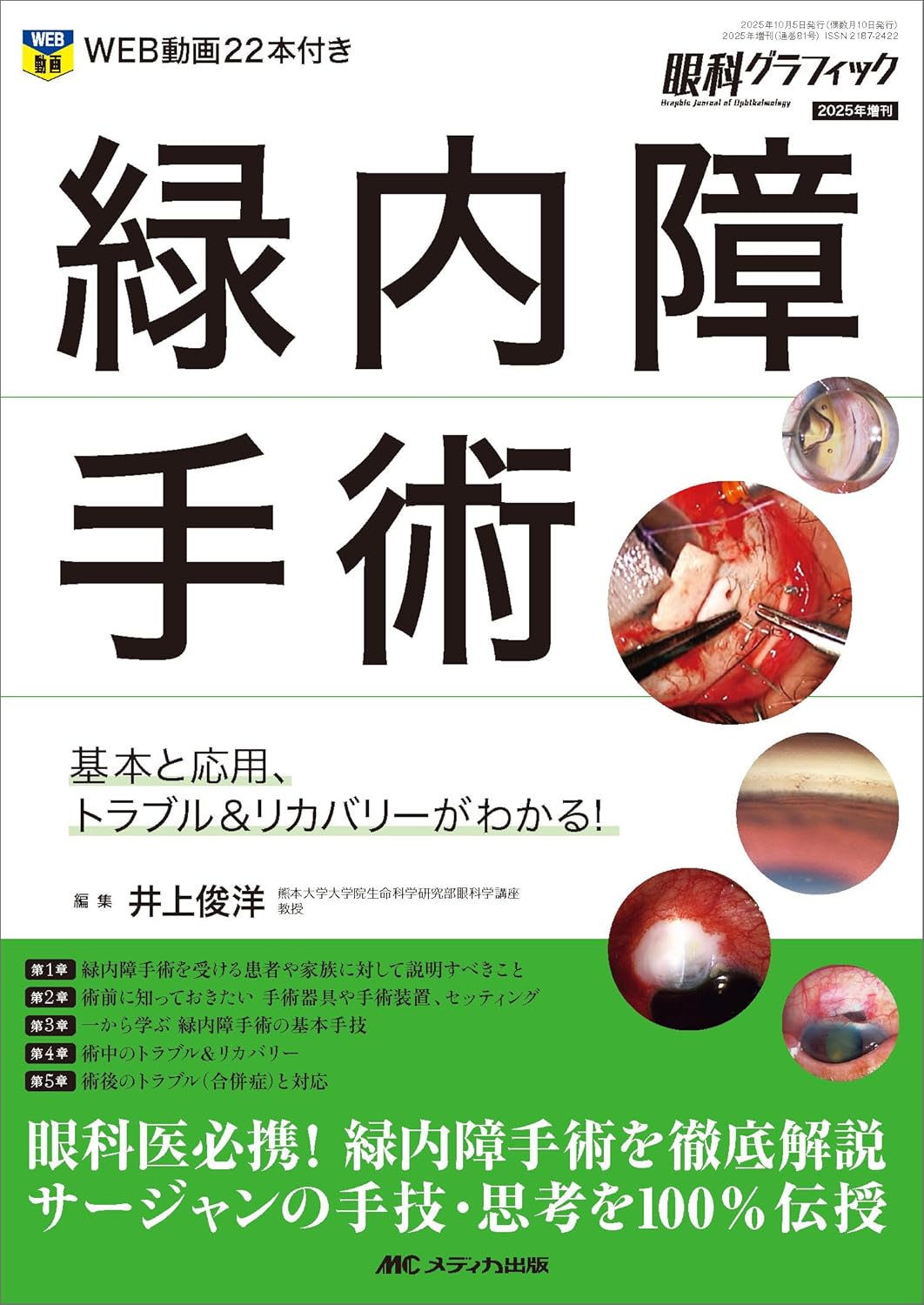 緑内障手術：基本と応用、トラブル＆リカバリーがわかる！ (眼科