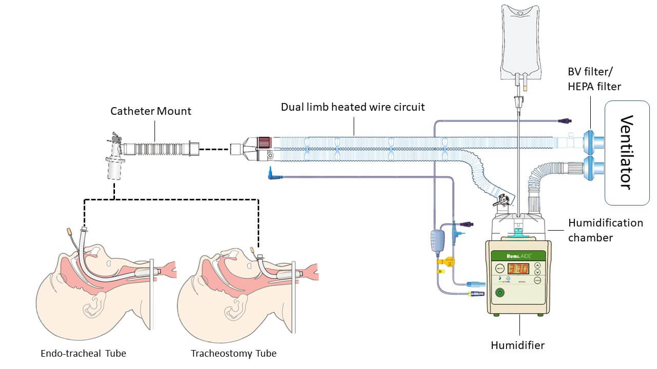 人工呼吸器とは何ですか？ GaleMedに説明させてください