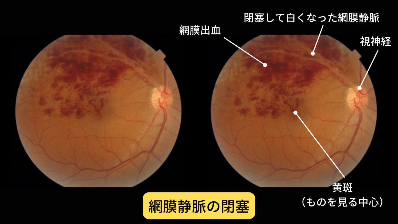 目の病気の早期発見のためには眼底検査が大切です。 | 日本眼科医会