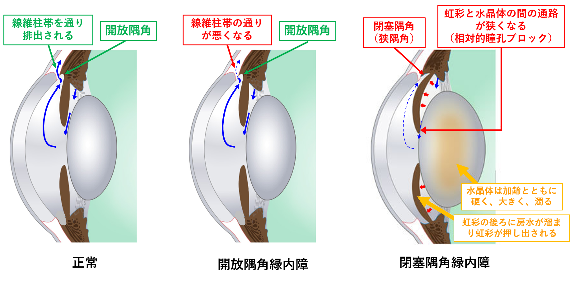 緑内障シリーズ3：予防できる緑内障と予防できない緑内障がある：閉塞