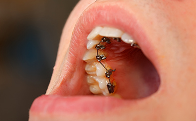 裏側矯正（舌側矯正）｜大阪・豊中・吹田の矯正歯科｜吉村矯正歯科