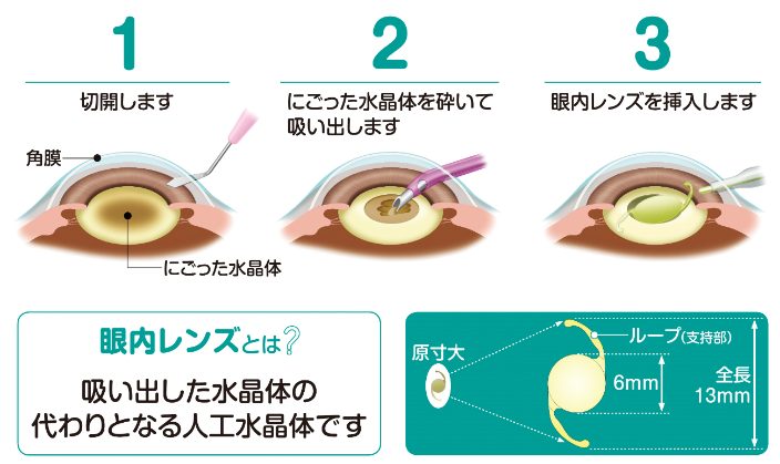 両眼同日白内障手術ならアイクリニック神楽坂 白内障と老眼を同時に治療