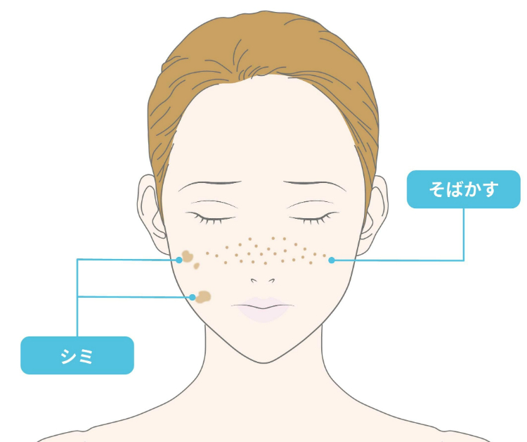 そばかすとシミの違いとは？見分け方や対策、ケアの方法を解説