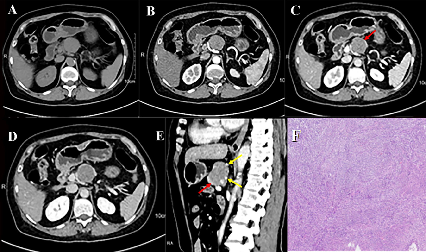 Frontiers | Imaging features of pancreatic extragastrointestinal