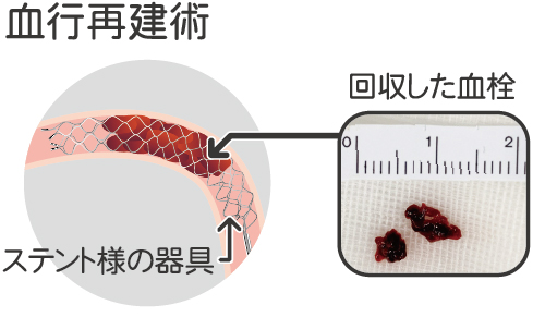 脳梗塞や脳出血など、脳の治療に血管内治療 | 岡山旭東病院