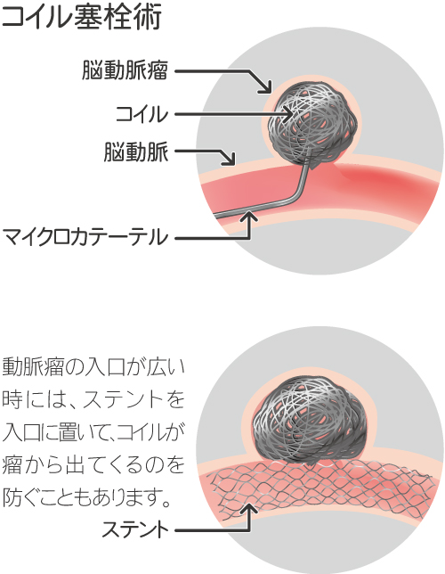 脳梗塞や脳出血など、脳の治療に血管内治療 | 岡山旭東病院