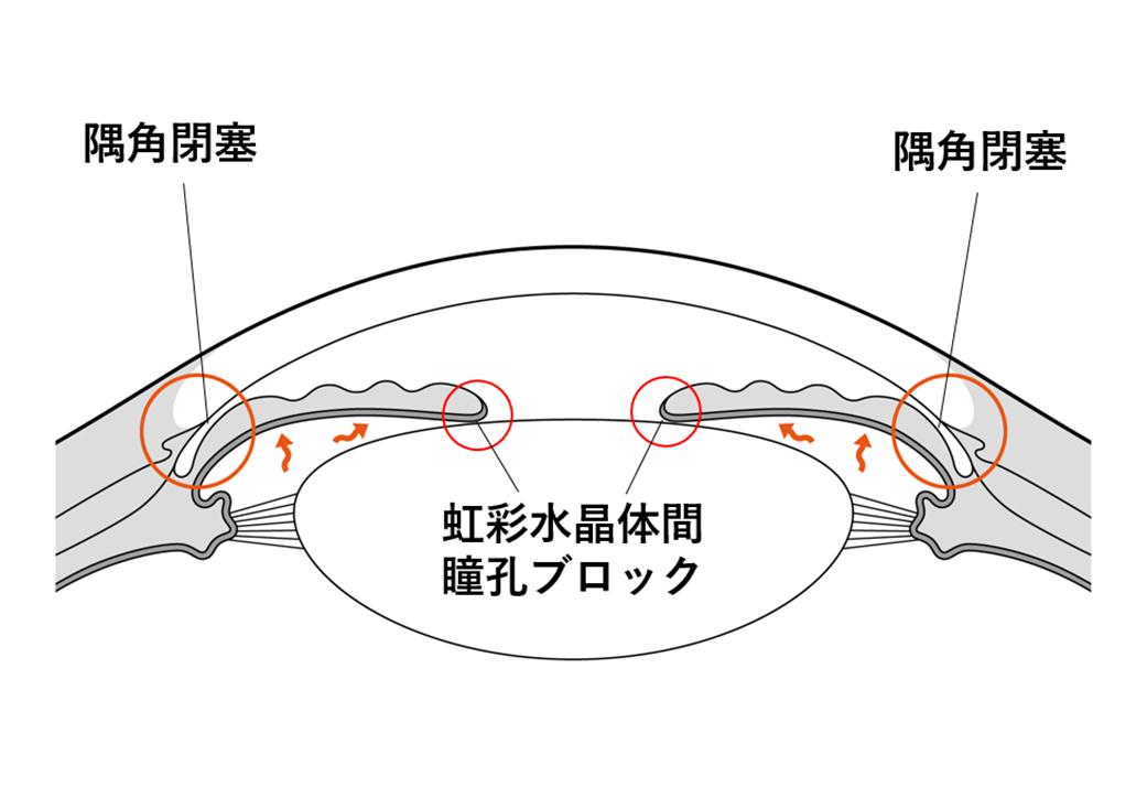緑内障｜大和駅の眼科｜大和ハナミズキ眼科