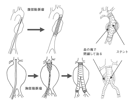 呼吸器外科／心臓血管外科 大動脈瘤に対する低侵襲治療