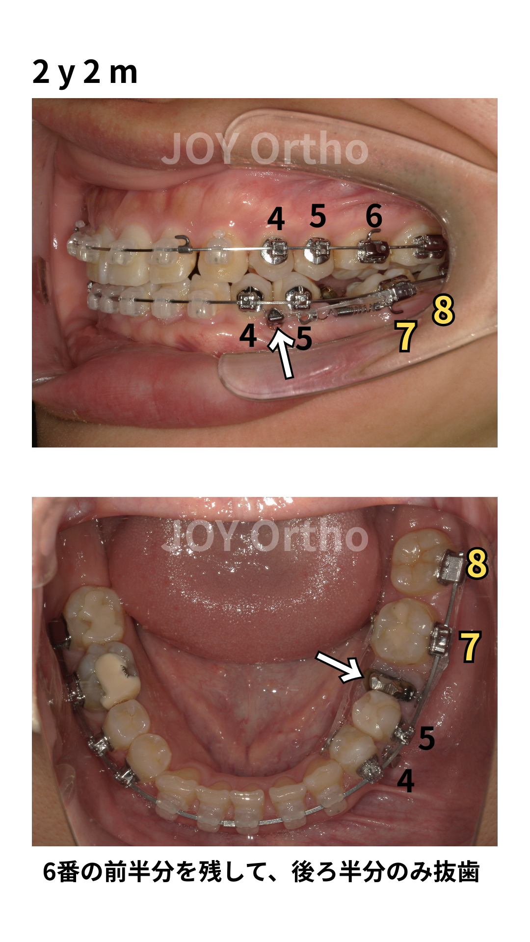 ブログ | 横浜市港北区【JOY矯正歯科クリニック】