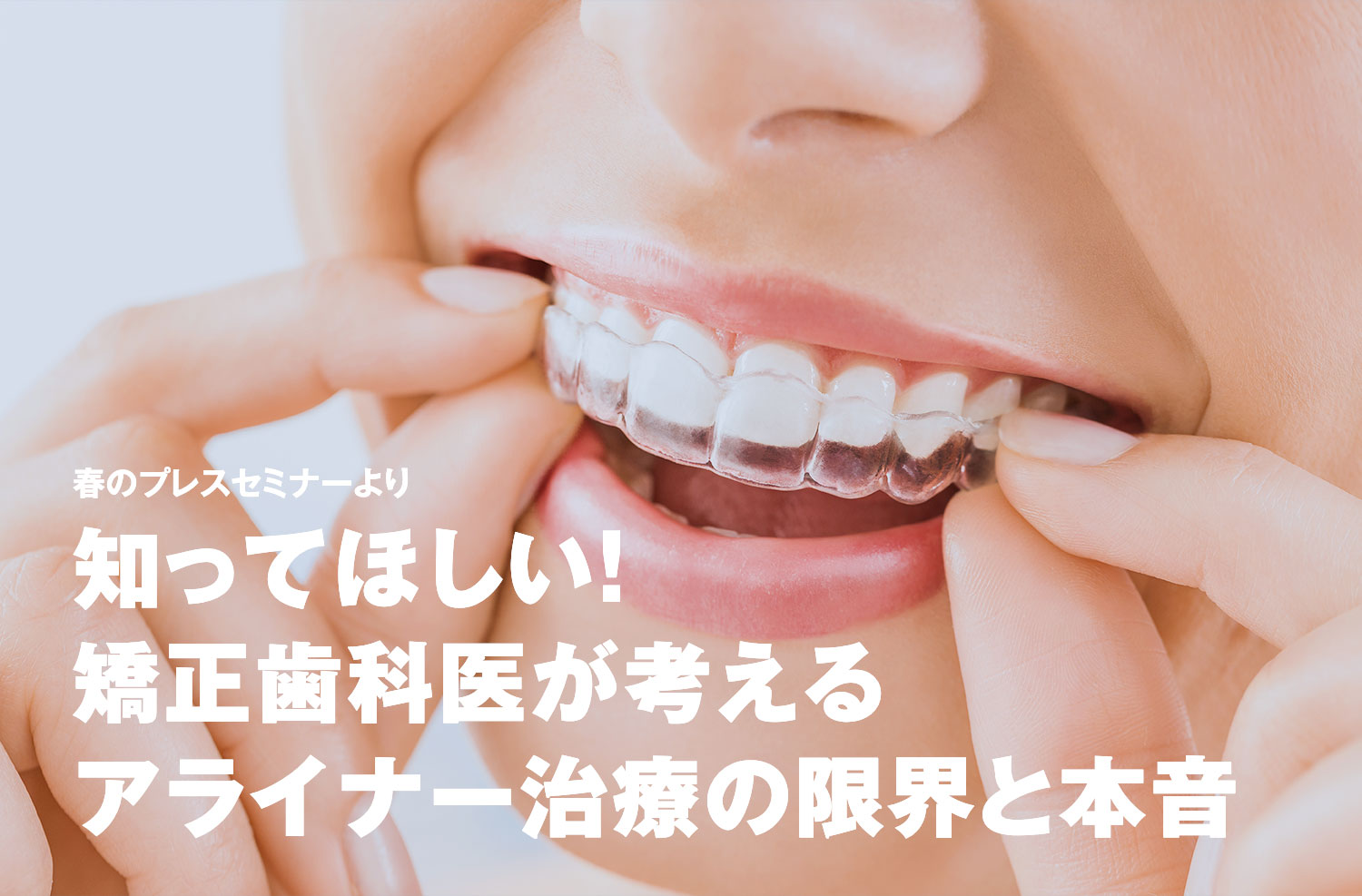 vol.30 知ってほしい！矯正歯科医が考えるアライナー治療の限界と本音