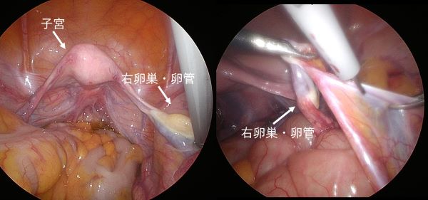 婦人科腫瘍｜鹿児島大学医学部産婦人科学教室