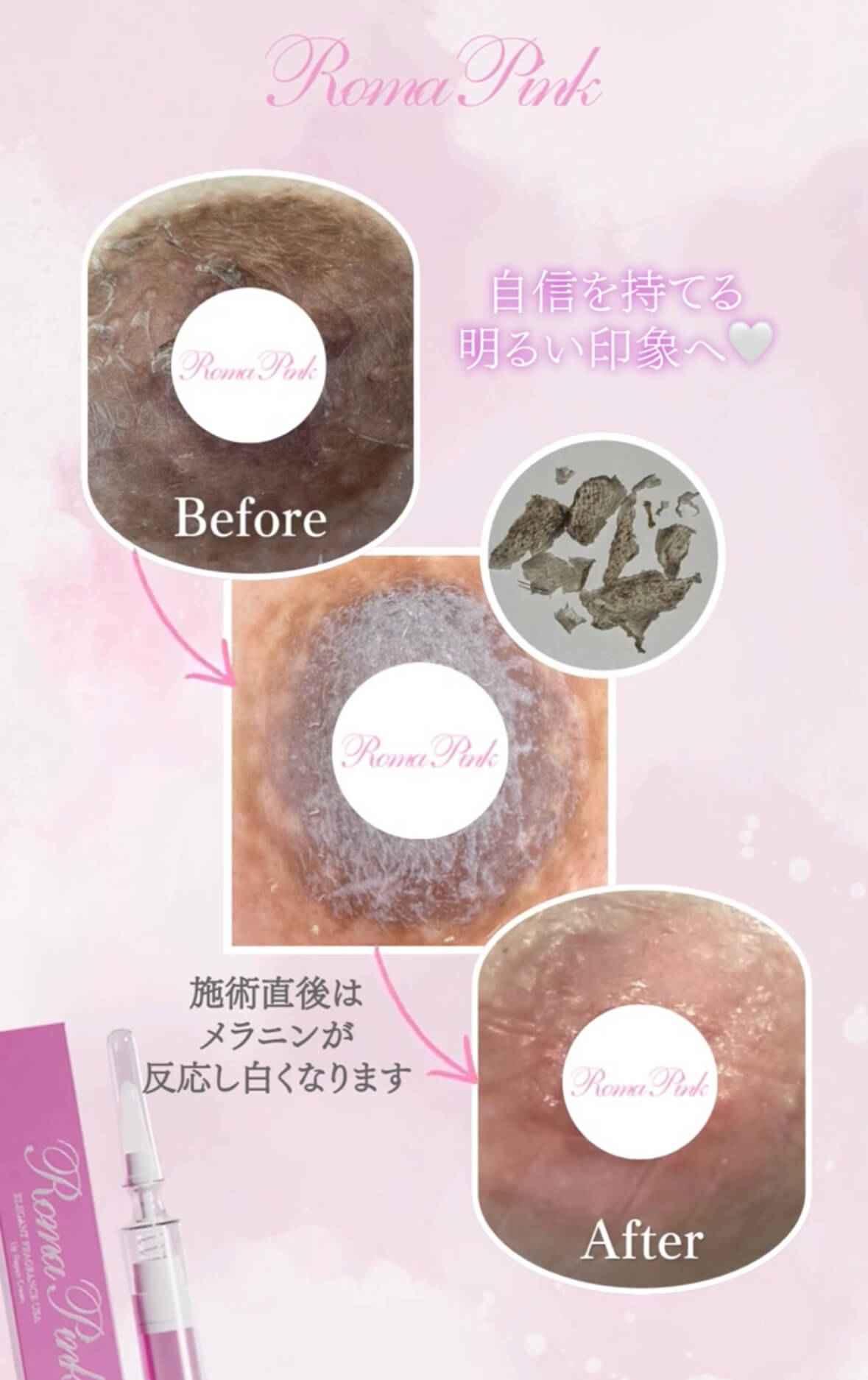 ROMAPINK】ローマピンクとは？“色ムラ・くすみ悩み”のためのケアを、肌