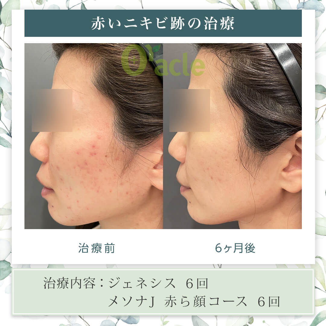 メソナJ｜【公式】オラクル美容皮膚科​