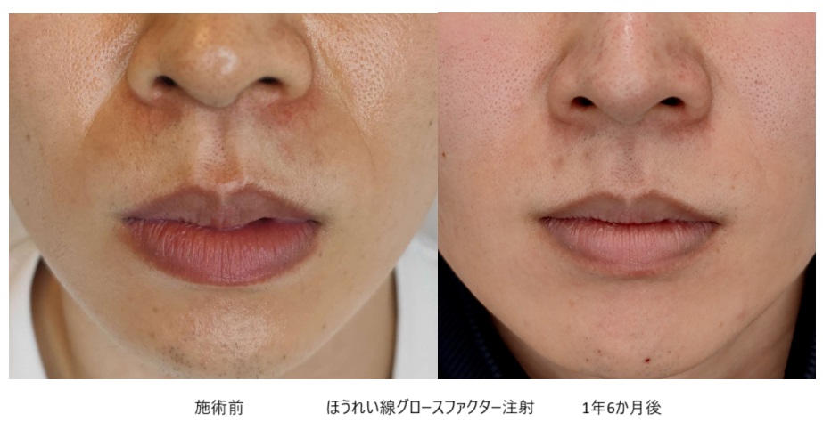 若いのにほうれい線が目立つ人の特徴と対策方法