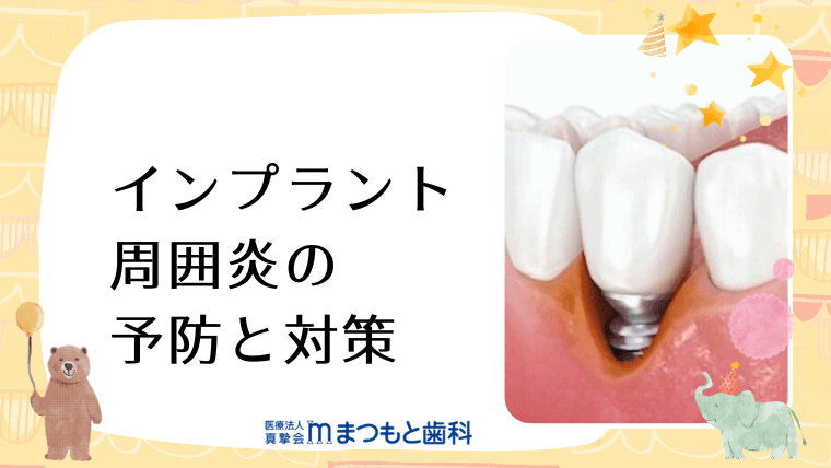 インプラント周囲炎の予防と対策｜まつもと歯科吹田本院 よくあるご質問