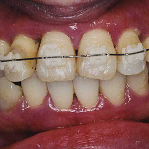 重度】30代女性「歯がボロボロ」インプラント10本以上必要と診断された