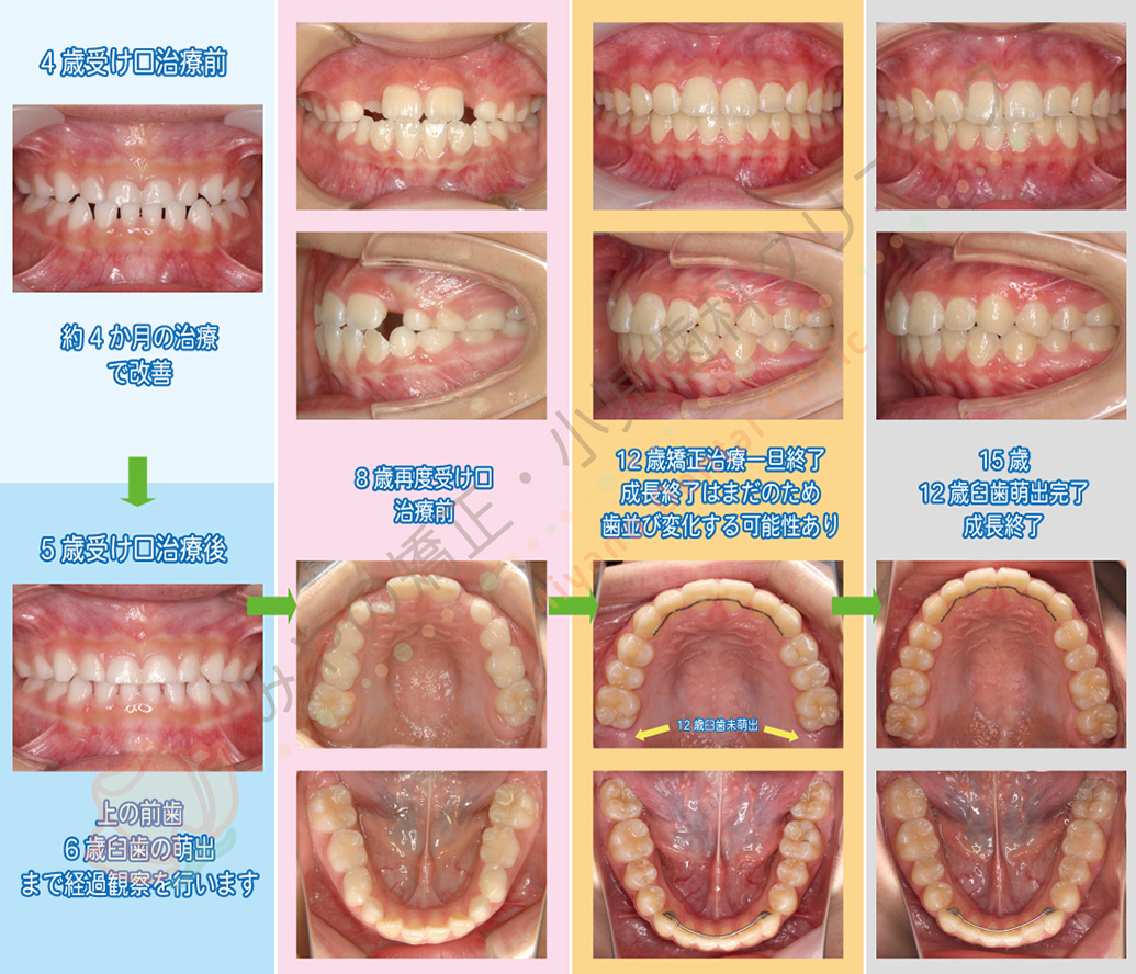 乳歯列期の矯正治療｜茨木市の歯医者（歯科医院）「みやの矯正・小児