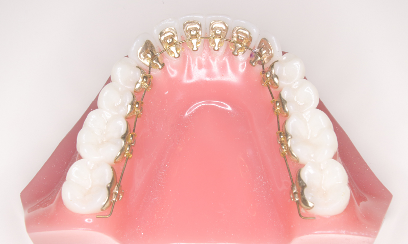 リンガルブラケット矯正治療 | 美帆矯正歯科クリニック