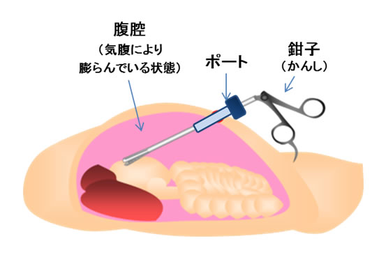 腹腔鏡下（ふくくうきょうか）手術について | 国立がん研究センター 東病院