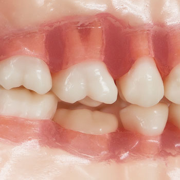 SRP実習用顎模型 [P15FE-MINT.1]｜株式会社ニッシン｜歯科模型・歯科