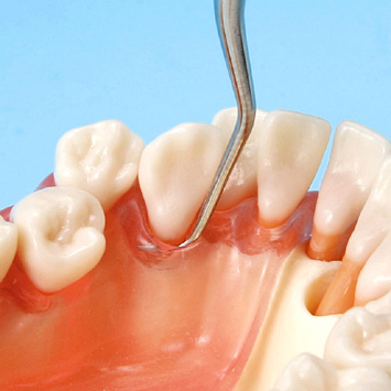 SRP実習用顎模型 [P15FE-X.770]｜株式会社ニッシン｜歯科模型・歯科