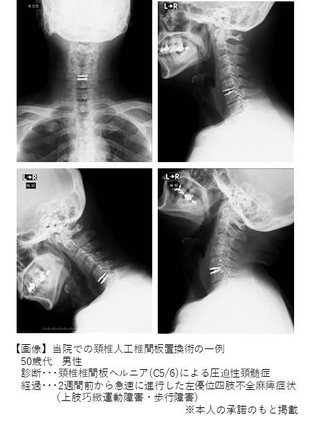 脊椎疾患の診察・治療・手術｜社会福祉法人恩賜財団 済生会滋賀県病院