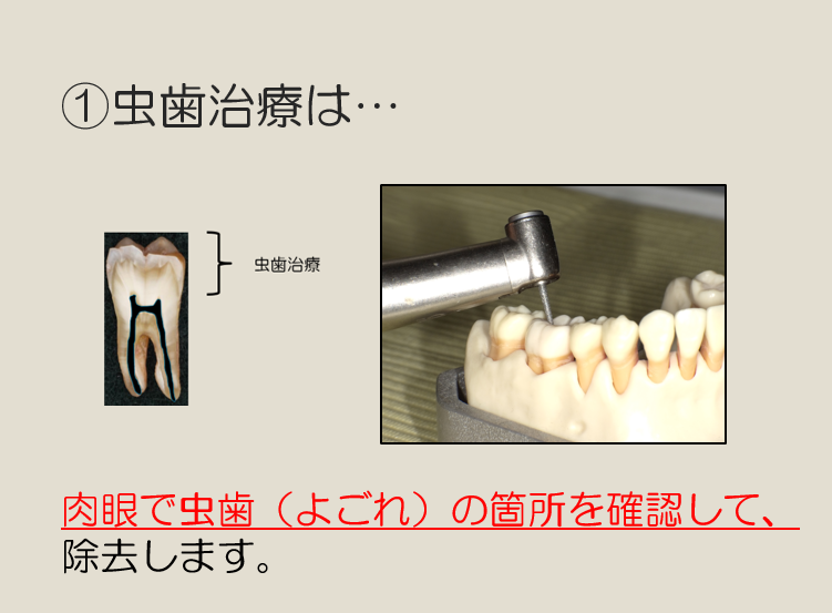 マイクロスコープを使った精密根管治療 – 医療法人 杏済会 坂詰歯科