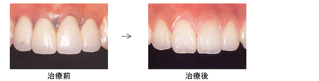 審美歯科治療 — 新宿区曙橋駅徒歩1分の歯医者・マウスピース矯正