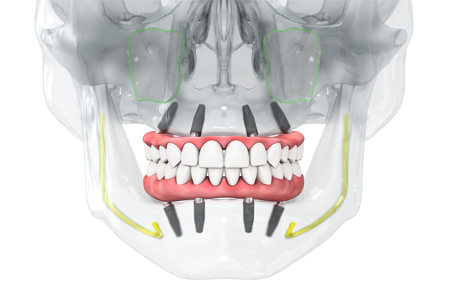ストローマンBLXインプラント｜品川デンタルケアクリニック審美歯科