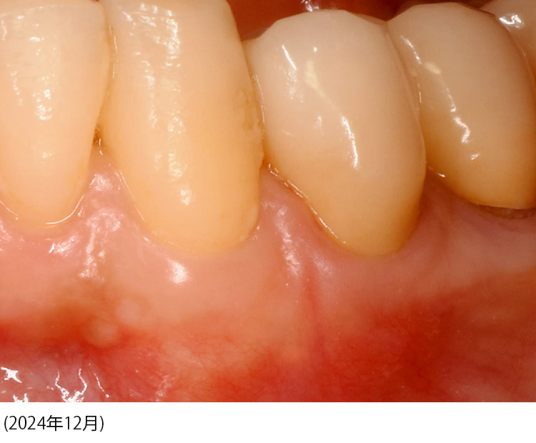 精密根管治療で抜歯せずに歯を保存した審美修復治療から14年10か月